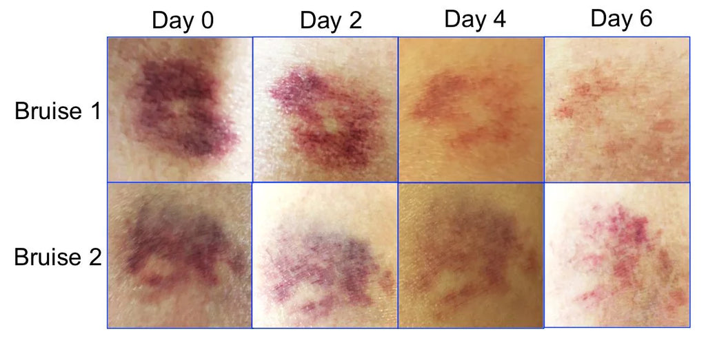 bruise NO bruise pack- ONE 3 WEEK, by Natural BruiseGONE CREAM, remedy healing Speeds